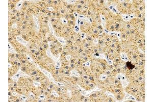 ABIN6257043 and ABIN6275490 at 1/100 staining human liver cancer by IHC-P. (ARHGAP17 anticorps  (Internal Region))