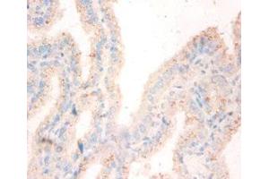 Immunohistochemistry of paraffin-embedded human bladder cancer using ABIN7162048 at dilution of 1:50 (NME1 anticorps  (AA 2-152))