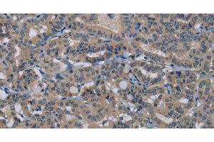 Immunohistochemistry of paraffin-embedded Human thyroid cancer tissue using HSPG2 Polyclonal Antibody at dilution 1:50 (HSPG2 anticorps)