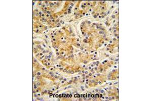 MOBKL1B Antibody IHC analysis in formalin fixed and paraffin embedded human Prostate carcinoma followed by peroxidase conjugation of the secondary antibody and DAB staining. (MOB1A anticorps  (C-Term))