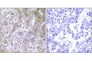 Immunohistochemistry analysis of paraffin-embedded human liver carcinoma tissue, using ACOT12 Antibody.