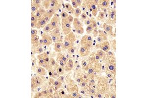 (ABIN6243863 and ABIN6578454) staining PYGL in human liver tissue sections by Immunohistochemistry (IHC-P - paraformaldehyde-fixed, paraffin-embedded sections). (PYGL anticorps  (AA 809-843))