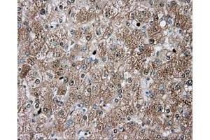 Immunohistochemical staining of paraffin-embedded Carcinoma of liver tissue using anti-TPMT mouse monoclonal antibody. (TPMT anticorps)
