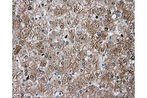 Immunohistochemical staining of paraffin-embedded Carcinoma of liver tissue using anti-TPMT mouse monoclonal antibody.