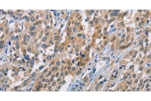 Immunohistochemistry of paraffin-embedded Human esophagus cancer using CBR1 Polyclonal Antibody at dilution of 1:40