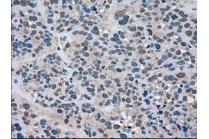 Immunohistochemical staining of paraffin-embedded Carcinoma of kidney tissue using anti-LDHAmouse monoclonal antibody. (Lactate Dehydrogenase A anticorps)