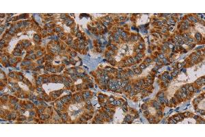 Immunohistochemistry of paraffin-embedded Human thyroid cancer using MRPL28 Polyclonal Antibody at dilution of 1:45