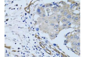 Immunohistochemistry of paraffin-embedded human breast cancer using MCAM antibody. (MCAM anticorps)
