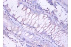 Immunohistochemistry of paraffin-embedded human colorectal carcinoma using PSMB4 antibody at dilution of 1:100. (PSMB4 anticorps)