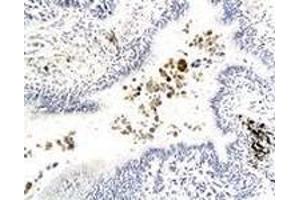 Immunohistochemiacl staining of human lung carcinoma tissue section with GPR182 polyclonal antibody  at 1:200 dilution. (G Protein-Coupled Receptor 182 anticorps)