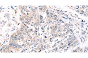 Immunohistochemistry of paraffin-embedded Human lung cancer tissue using ROR1 Polyclonal Antibody at dilution 1:45