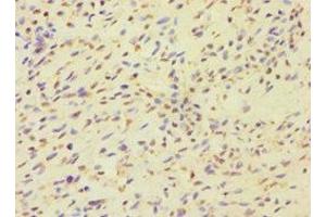 Immunohistochemistry of paraffin-embedded human breast cancer using ABIN7159821 at dilution of 1:100 (MCMBP anticorps  (AA 1-240))