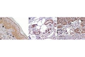 Expression of MC1R in normal skin and melanoma - Immunohistochemical staining of paraffin embedded normal skin and melanoma sections using Anti-MC1 Receptor Antibody (ABIN7043321, ABIN7044592 and ABIN7044593) (1:100).