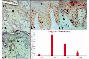 The effects of ustekinumab and CUC on PCNA IE in IQ-induced psoriatic skin lesions. (PCNA anticorps)