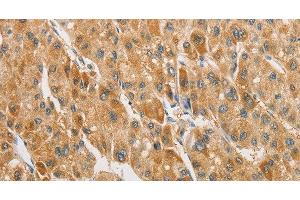 Immunohistochemistry of paraffin-embedded Human liver cancer tissue using ARHGAP5 Polyclonal Antibody at dilution 1:30 (ARHGAP5 anticorps)