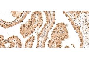 Immunohistochemistry of paraffin-embedded Human thyroid cancer tissue using LGALS4 Polyclonal Antibody at dilution of 1:30(x200)