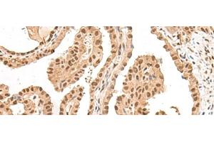 Immunohistochemistry of paraffin-embedded Human thyroid cancer tissue using LGALS4 Polyclonal Antibody at dilution of 1:30(x200) (GAL4 anticorps)