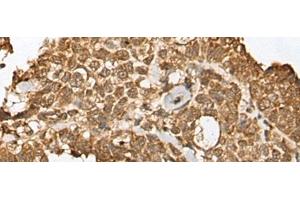 Immunohistochemistry of paraffin-embedded Human ovarian cancer tissue using RBL2 Polyclonal Antibody at dilution of 1:45(x200) (p130 anticorps)