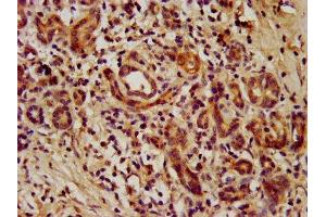 IHC image of ABIN7172763 diluted at 1:1000 and staining in paraffin-embedded human pancreatic cancer performed on a Leica BondTM system. (TEAD3 anticorps  (AA 112-435))