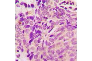 Immunohistochemical analysis of Beta-tubulin staining in human breast cancer formalin fixed paraffin embedded tissue section.