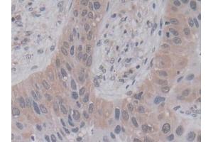 DAB staining on IHC-P; Samples: Human Lung cancer Tissue (PPIA anticorps  (AA 2-165))
