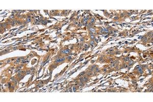Immunohistochemistry of paraffin-embedded Human gastric cancer using GNA13 Polyclonal Antibody at dilution of 1:30 (GNA13 anticorps)