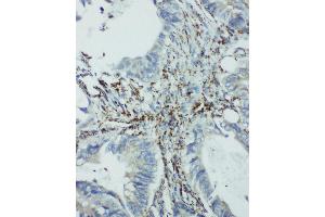 Anti-integrin beta 4 binding protein antibody, IHC(P) IHC(P): Human Intestinal Cancer Tissue (EIF6 anticorps  (Middle Region))