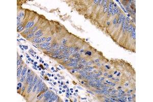 Immunohistochemistry of paraffin-embedded Human colon cancer using IL9 Polyclonal Antibody at dilution of 1:200 (40x lens). (IL-9 anticorps)