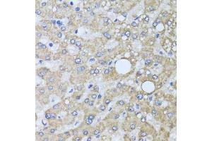 Immunohistochemistry of paraffin-embedded human liver injury using AARS2 antibody. (AARS2 anticorps)