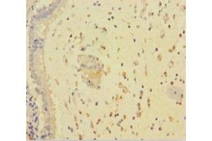 Immunohistochemistry of paraffin-embedded human lung cancer using ABIN7167811 at dilution of 1:100