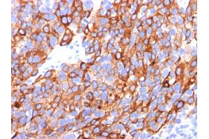 Formalin-fixed, paraffin-embedded human Melanoma stained with MART-1 / Melan-A Monoclonal Antibody (A103+M2-7C10+M2-9E3).
