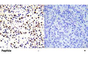 Immunohistochemical analysis of paraffin-embedded human malignant lymphoma tissue using HIST1H3E (phospho T3) polyclonal antibody . (HIST1H3E anticorps  (pThr3))