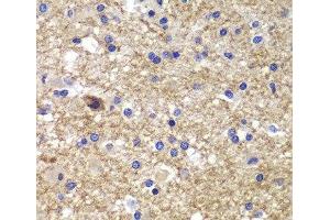 Immunohistochemistry of paraffin-embedded Human brain cancer using CDK6 Polyclonal Antibody at dilution of 1:100 (40x lens). (CDK6 anticorps)