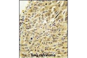 Formalin-fixed and paraffin-embedded human lung carcinoma tissue reacted with Dsk2 Antibody (N-term) (ABIN388963 and ABIN2839210) , which was peroxidase-conjugated to the secondary antibody, followed by DAB staining. (Ubiquilin 1 anticorps  (N-Term))