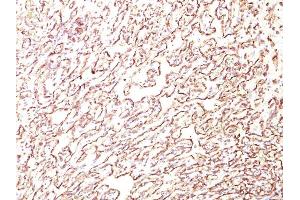 Formalin-fixed, paraffin-embedded human Angiosarcoma stained with Podocalyxin Monoclonal Antibody (4F10). (PODXL anticorps  (Extracellular Domain))