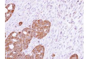 IHC-P Image Immunohistochemical analysis of paraffin-embedded NCIN87 xenograft, using TCP-1 epsilon, antibody at 1:500 dilution.