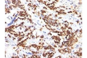 Formalin-fixed, paraffin-embedded human breast carcinoma stained with MFGE8 antibody (MFG-06)