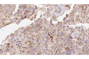 ABIN6278123 at 1/100 staining Human Melanoma tissue by IHC-P. (APOC3 anticorps  (Internal Region))