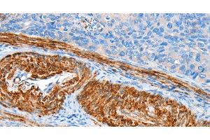 Immunohistochemistry of paraffin-embedded Human cervical cancer tissue using AARS Polyclonal Antibody at dilution 1:60 (AARS anticorps)