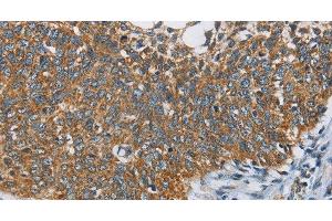 Immunohistochemistry of paraffin-embedded Human cervical cancer tissue using ANKHD1 Polyclonal Antibody at dilution 1:40