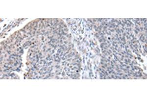 Immunohistochemistry of paraffin-embedded Human lung cancer tissue using ZNF23 Polyclonal Antibody at dilution of 1:50(x200) (ZNF23 anticorps)