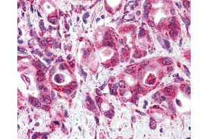 Anti-GLP1R/GLP-1R/GLP-1 Receptor antibody IHC of human Pancreas, Carcinoma.