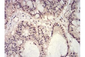 Immunohistochemical analysis of paraffin-embedded colon cancer tissues using HIST2H3C(27Ac) mouse mAb with DAB staining.