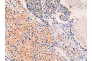 IHC-P analysis of Human Lung Cancer Tissue, with DAB staining. (OIT3 anticorps  (AA 297-506))