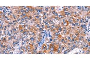Immunohistochemistry of paraffin-embedded Human liver cancer tissue using ELP2 Polyclonal Antibody at dilution 1:40 (ELP2 anticorps)