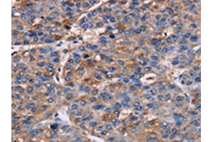 The image on the left is immunohistochemistry of paraffin-embedded Human liver cancer tissue using ABIN7130450(NPM3 Antibody) at dilution 1/60, on the right is treated with fusion protein.