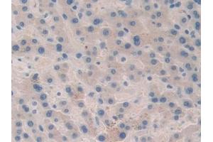 Detection of F5 in Human Liver cancer Tissue using Polyclonal Antibody to Coagulation Factor V (F5) (Coagulation Factor V anticorps  (AA 463-715))