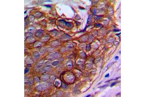 Immunohistochemical analysis of NPDC1 staining in human prostate cancer formalin fixed paraffin embedded tissue section.