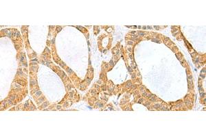 Immunohistochemistry of paraffin-embedded Human thyroid cancer tissue using PPIH Polyclonal Antibody at dilution of 1:60(x200) (PPIH anticorps)