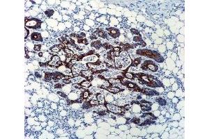 TGFB2 antibody immunohistochemistry analysis in formalin fixed and paraffin embedded human colon carcinoma